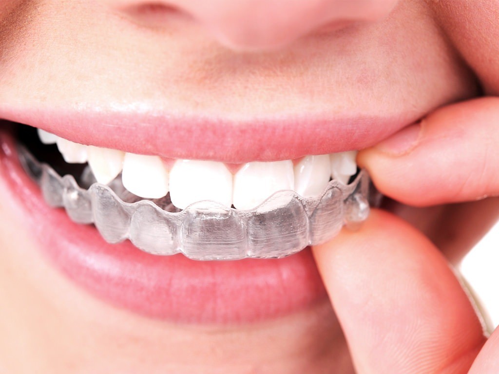 braces quotes columbia sc 